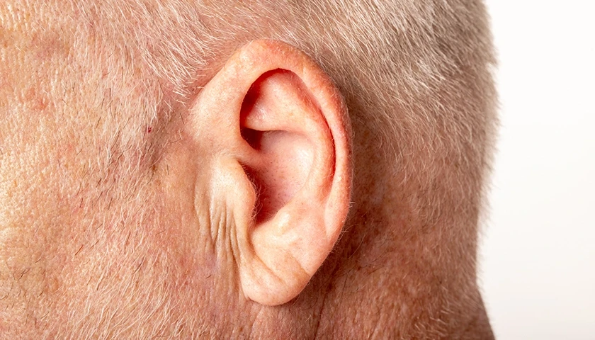 Detalle de un lóbulo de la oreja de un hombre con el signo de Frank o pliegue diagonal..webp
